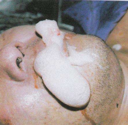 古代的仵作是怎么解剖尸体来观察蕈样泡沫的呢