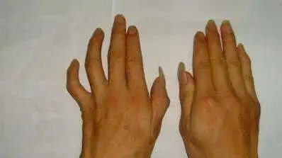 手麻不都是颈椎病———肘管综合征 - 知乎