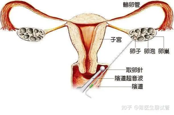 试管婴儿过程痛苦吗？特殊情况之取卵后出血与感染- 知乎