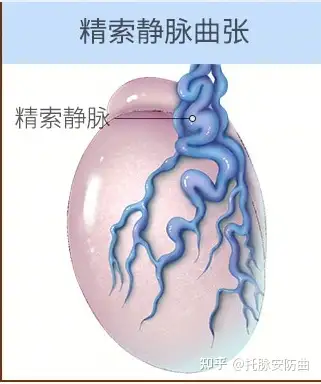 精索静脉曲张可能导致睾丸萎缩 主要是在10-14岁儿童人群概率高一些