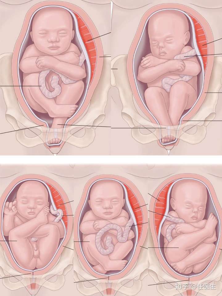 各种胎位图片图片