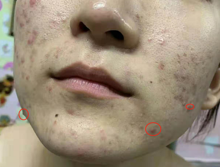 脸上长了大脓包该怎么处理