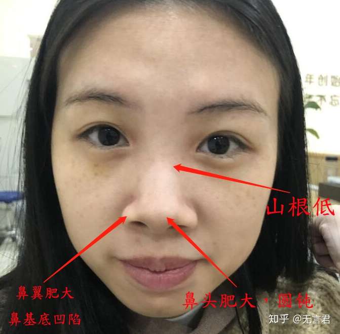 隆鼻时医生为什么喜欢推荐做鼻综合?