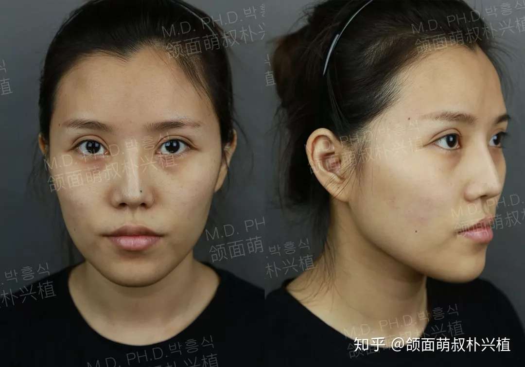 那个做了双鄂手术的妹子 术后半年了 知乎 那个做了双鄂手术的妹子 术后半年了 知乎