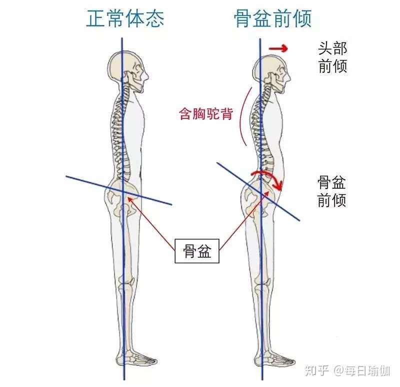 矫正骨盆前倾 每天只需5分钟 知乎