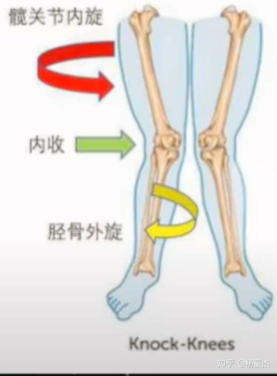 如果运动量的大话很容易造成损失,会让其踝关节处于外翻位,膝关节处于