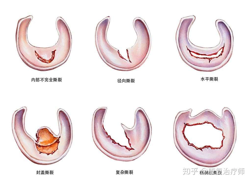 半月板损伤了 选择修复还是切除 知乎