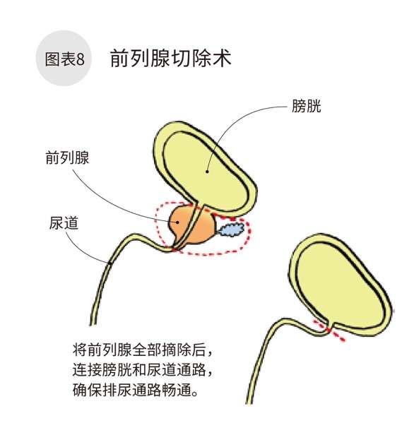 日本专家谈肿瘤 前列腺癌 知乎