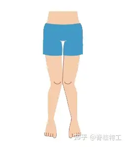 xo型腿如何自测如何矫正