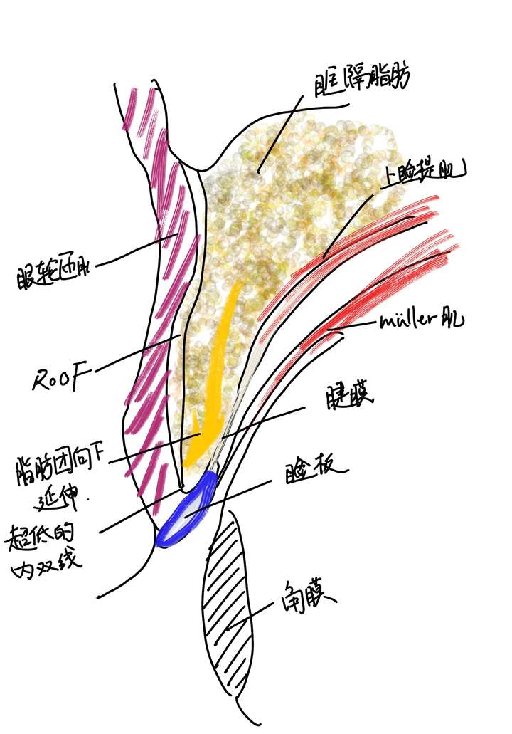 对自然的模仿重睑成形术原理丨眼部整形系列科普第三篇