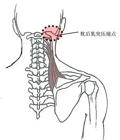 肩颈突然痛到不能动,年轻人肩颈疼怎么调理插图3 肩颈突然痛到不能动,年轻人肩颈疼怎么调理插图3