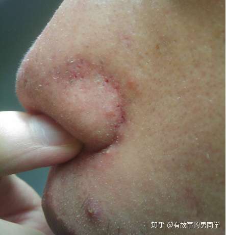 我的鼻子因为挤黑头成这个样子了 怎么恢复啊啊啊啊啊啊啊!