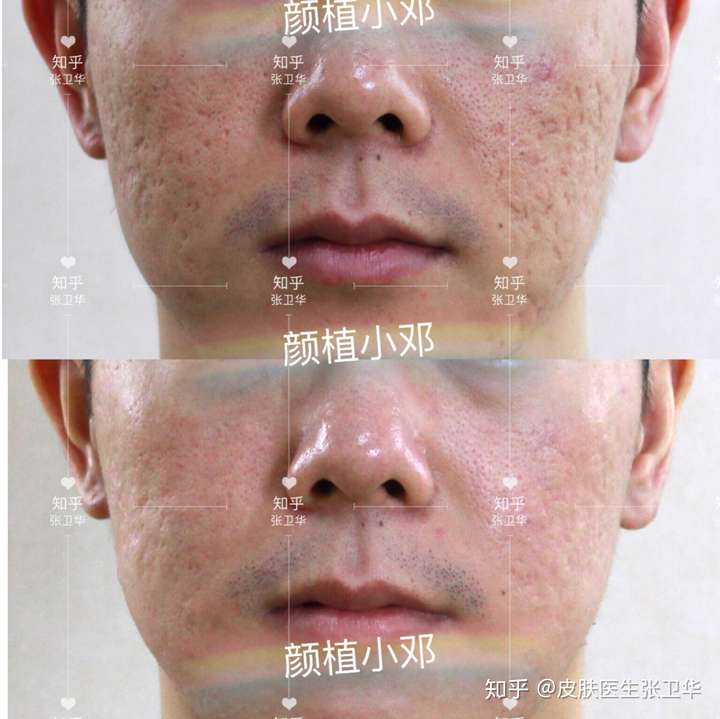 武汉的痘坑患者做了两组治疗后的效果对比
