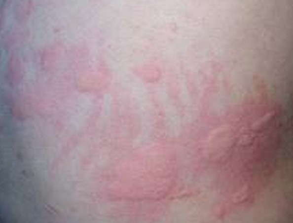 一碗抗敏煎 轻松解决荨麻疹 李志忠主治医师 爱问医生