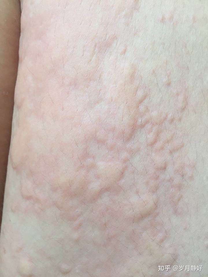 你们的慢性荨麻疹都是怎么治疗的