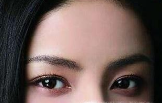 做双眼皮手术多久才能恢复(双眼皮术后多久可以恢复)插图 做双眼皮手术多久才能恢复(双眼皮术后多久可以恢复)插图