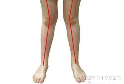 第一个正常腿型,2和4腿型就是我们常说的膝外翻型x腿和股骨内旋型ox腿