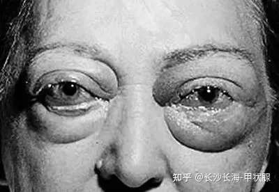 健康小知识甲亢突眼的危害和日常生活保养的方法