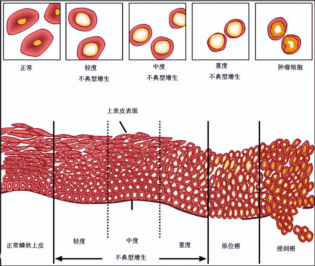 派特灵生物科普 宫颈低级别上皮内瘤变4大要点 知乎