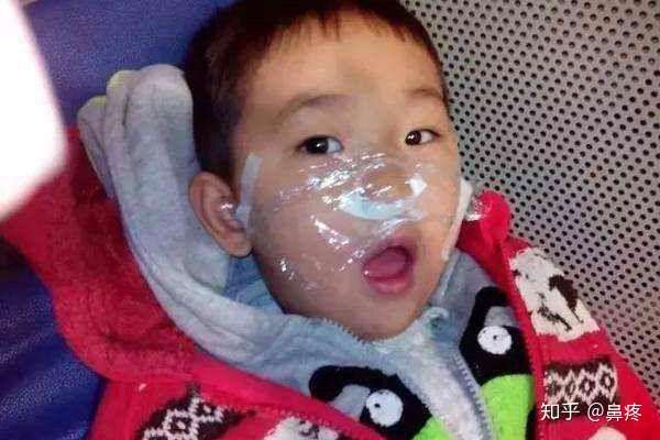 鼻炎 鼻窦炎 过敏性鼻炎还傻傻分不清 不同症状 护理方法不同 知乎