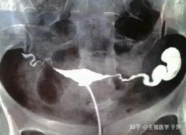 成都助孕试管（青岛助孕专家于萍：为什么输卵管会积水？输卵管积水还能自然怀孕吗？）