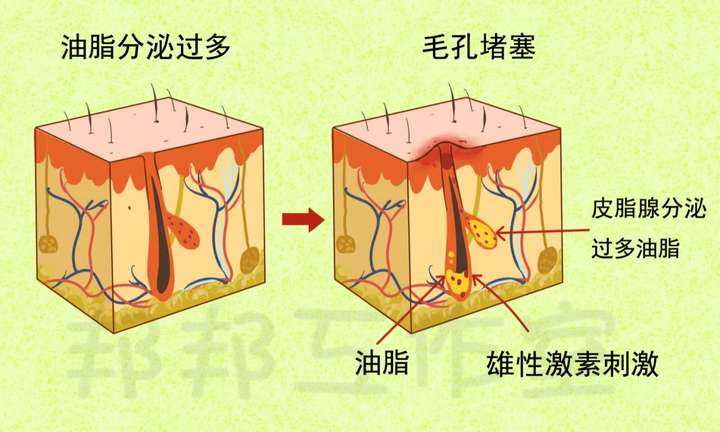 還很容易堵塞毛囊口,導致毛囊口的角化異常,使得皮脂不能正常排出而容