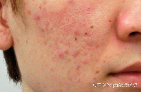 怎么去除皮肤的痘印和鸡皮(怎么去除皮肤的痘印和鸡皮疙瘩)