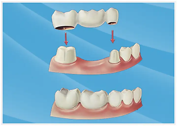 避雷！西安诺贝尔口腔医院告诉您：种牙常见的3大误区！