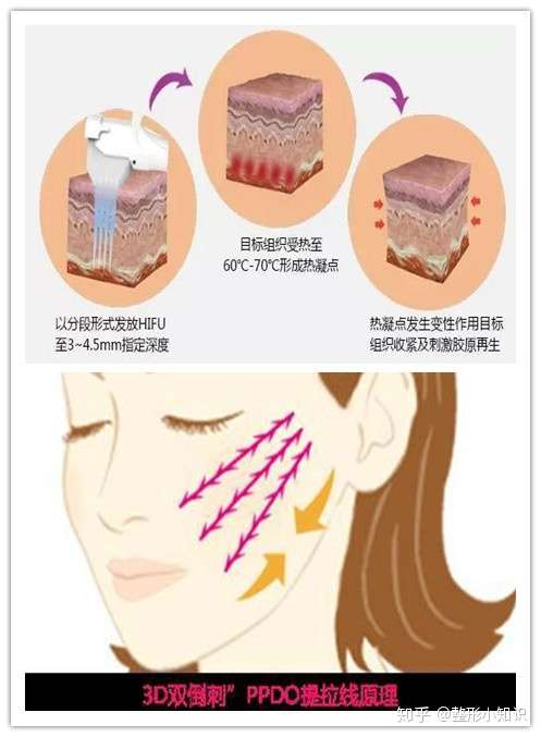 线雕 超声刀30岁左右抗初老 是选择超声刀还是线雕 知乎