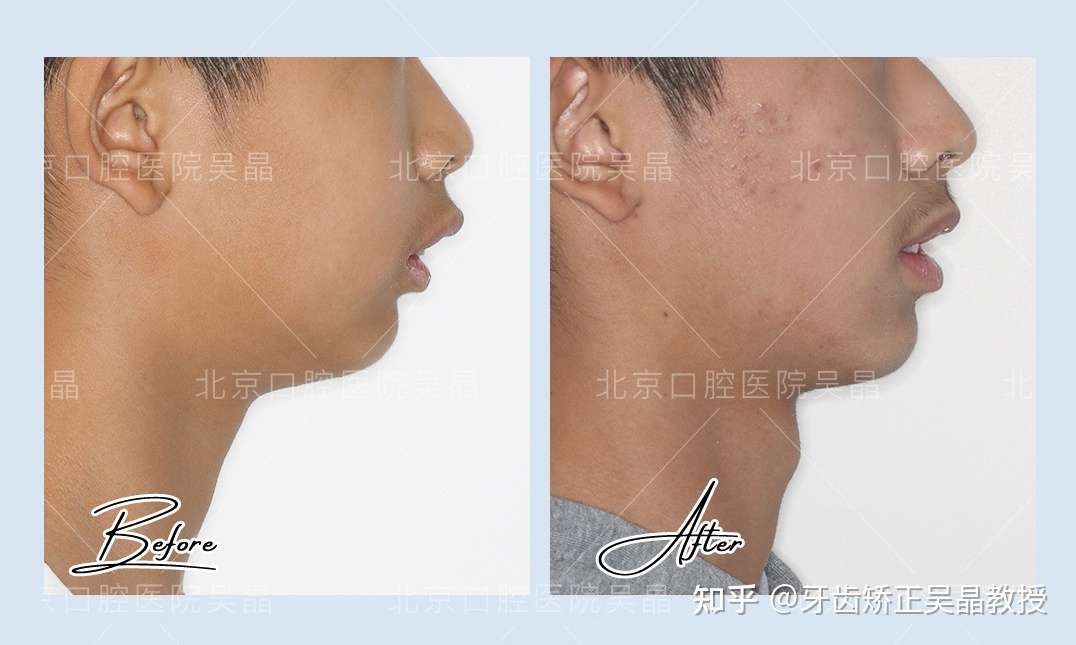 下颌后缩 矫正牙齿真的能达到改头换面的效果吗 知乎