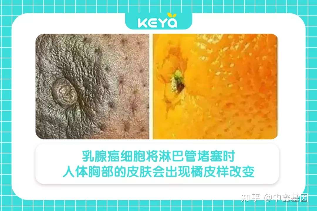 12颗柠檬 看懂12种乳癌症状 肿瘤不再是唯一状态 星女圈