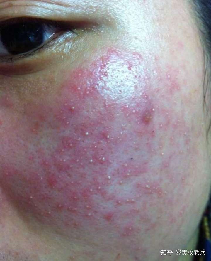 请问到底什么皮肤是敏感肌?