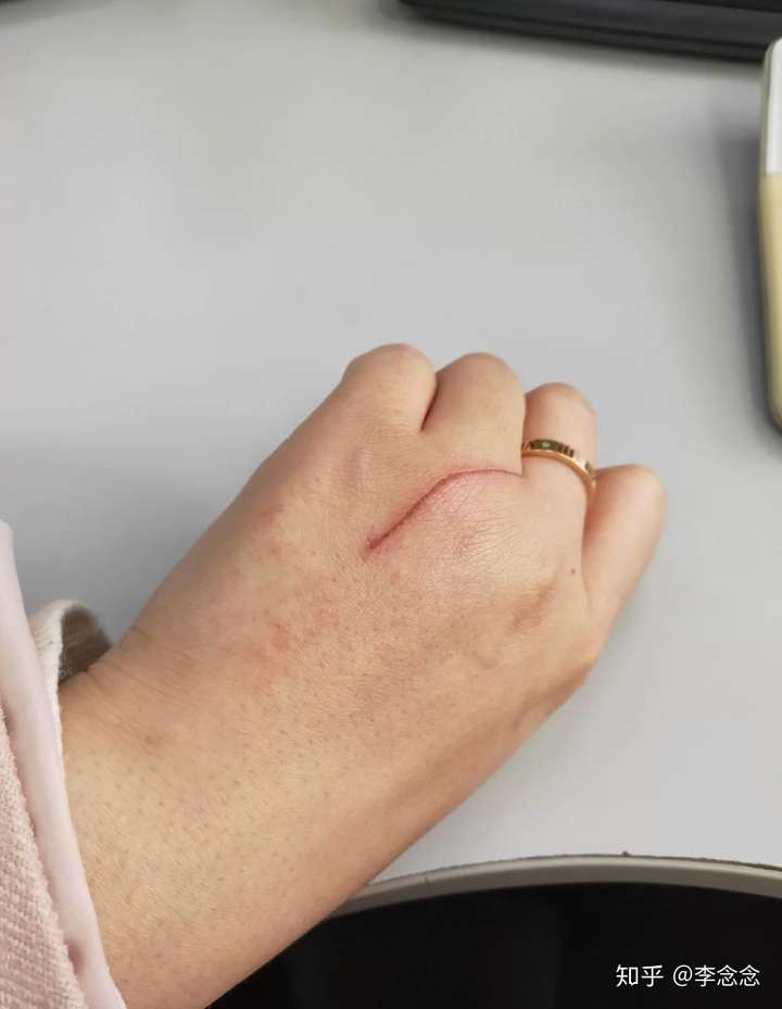 今年3月不小心被猫抓破了,留了很深的疤痕~ (请忽略我略显粗犷的手,一