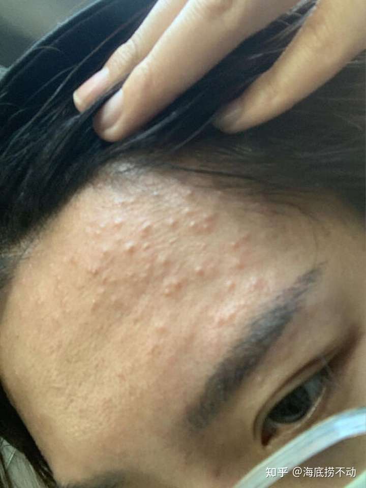 脸颊两边长鸡皮疙瘩的图片(脸颊两边长鸡皮疙瘩的图片女)