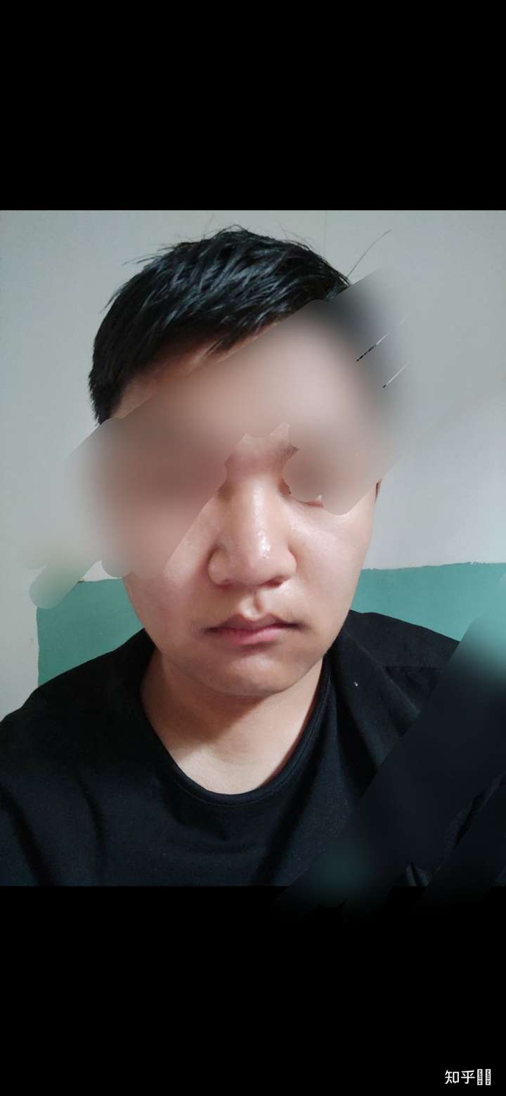 有一个肉鼻子是怎样的体验?