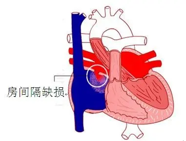 房间隔缺损