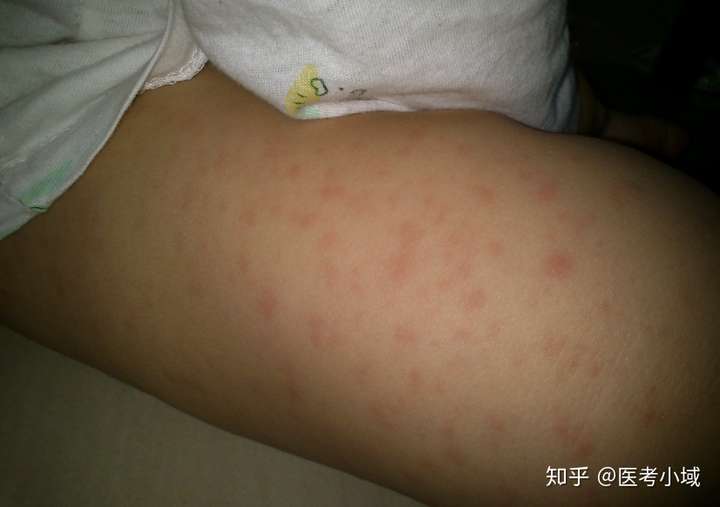 概念 风疹是由外感风疹时邪(风疹病毒)引起的一种急性出