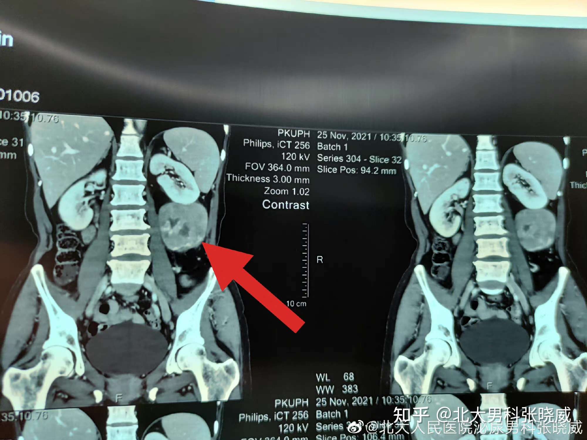 北大男科张晓威 的想法 今日之典型病例:肾下极肿瘤,行开放手术