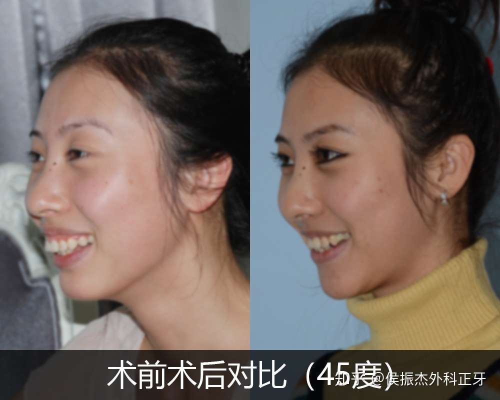 做正颌手术什么年龄最合适 知乎