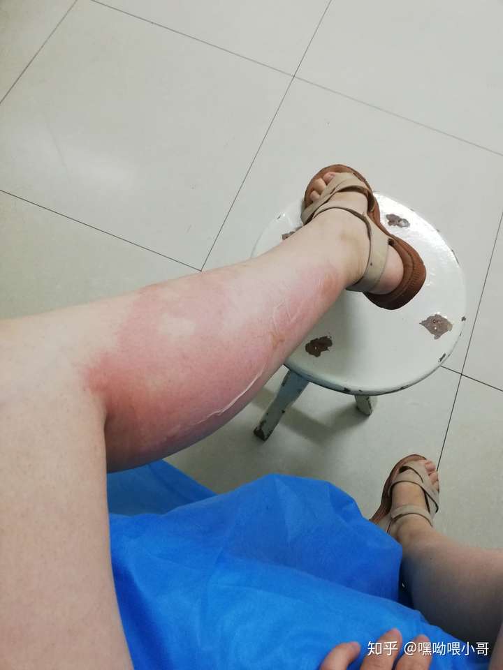 浅二度烫伤恢复