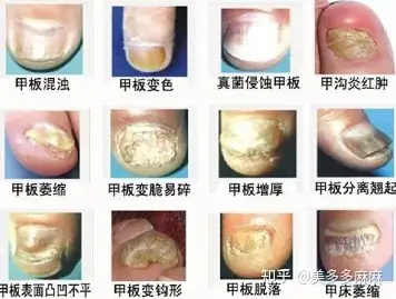 厚指甲一坨图片