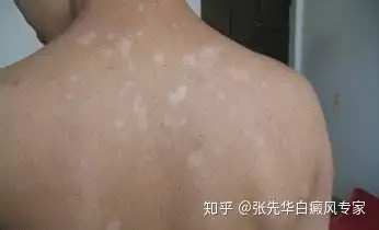 发现背上长了白斑怎么办要怎么治疗呢