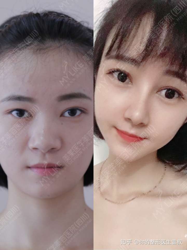 一点鼻梁都没有怎么办
