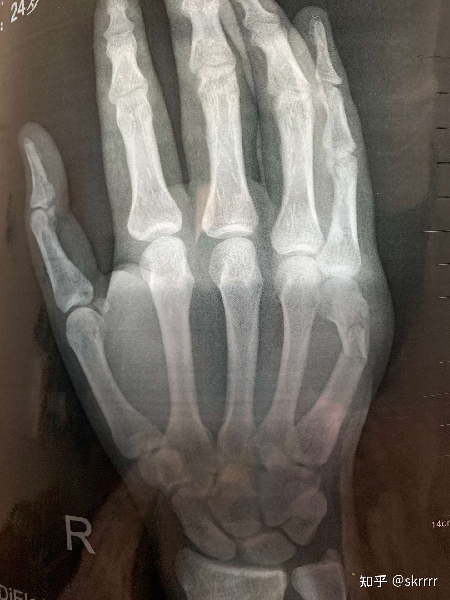 右手第五掌骨骨折 知乎