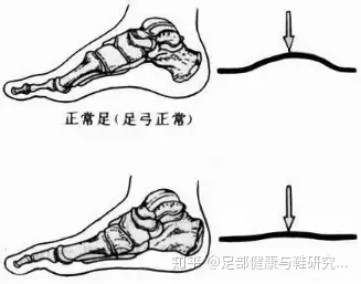 足弓扁平足跟痛儿童鞋应有足弓垫