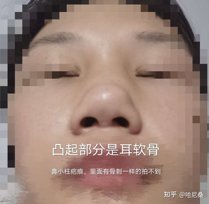 在广州做的隆鼻 术后呼吸不畅 鼻小柱弯曲 山根歪斜 知乎