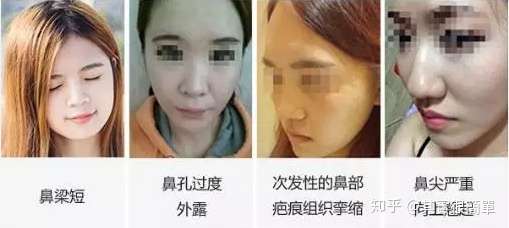 朝天鼻矫正效果好吗 知乎