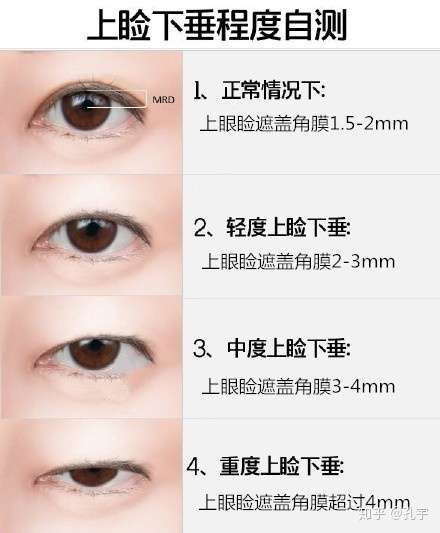 你好,看你的图片是明显的上睑下垂和眼睑皮肤松弛.