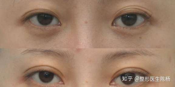 失败双眼皮的症状表现有哪些 修复方法及最佳时间是 知乎