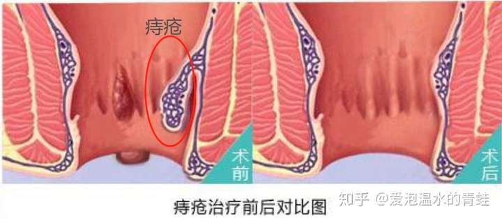 痔疮线扎法图片欣赏图片